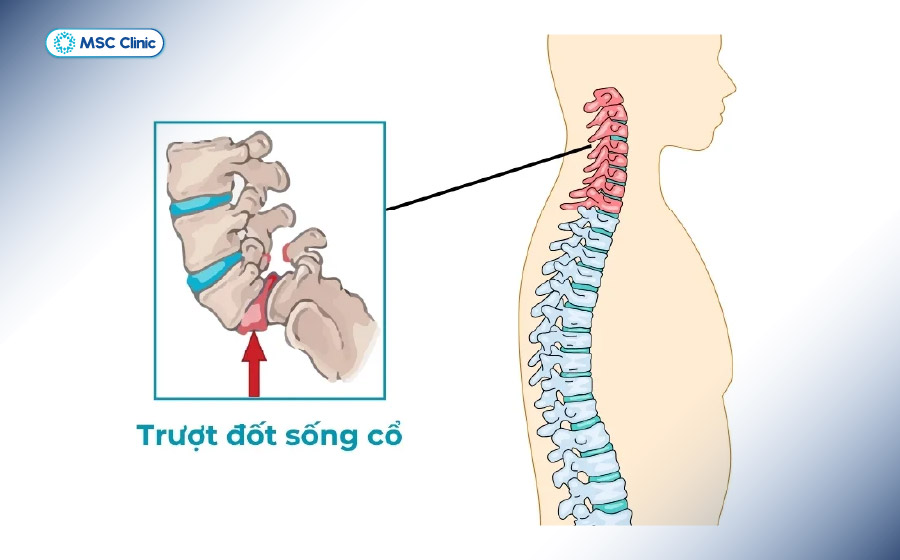 Trật khớp đốt sống cổ là chấn thương cột sống cổ nguy hiểm