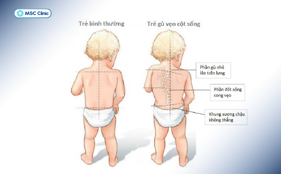 Trẻ nhỏ có thể bị cong vẹo cột sống không có nguyên nhân rõ ràng