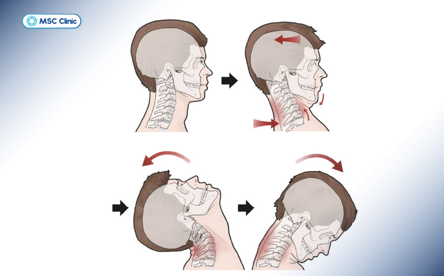 Va chạm trực tiếp gây ra hội chứng giật cổ 