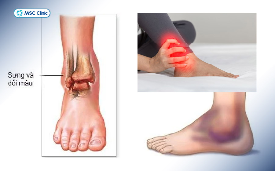 Vận động trở lại quá sớm sau bong gân là nguyên nhân phổ biến gây viêm dây chằng ở người chơi thể thao