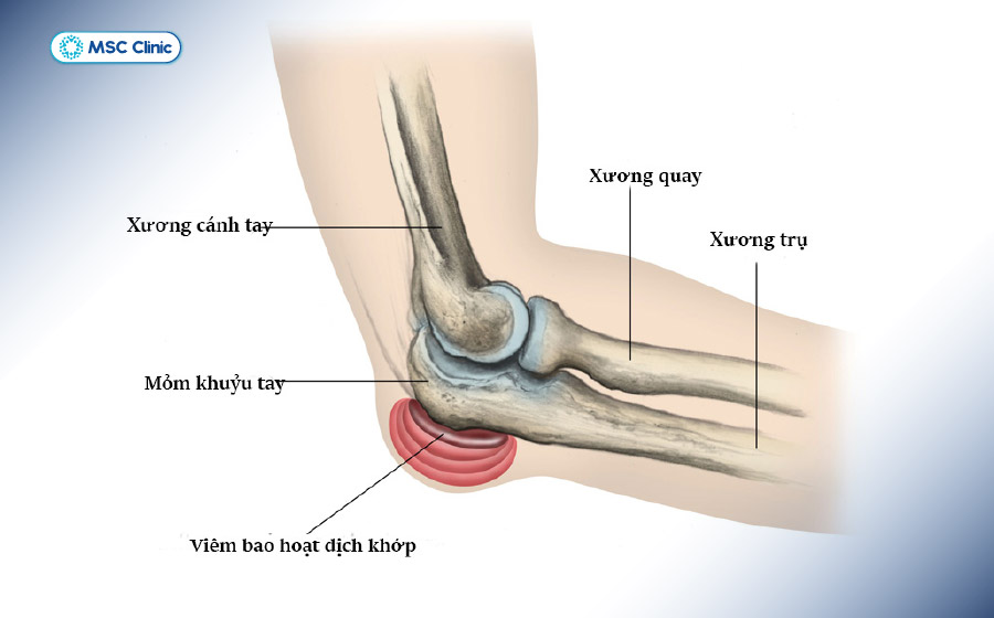 Viêm bao hoạt dịch gây đau nhức khuỷu tay