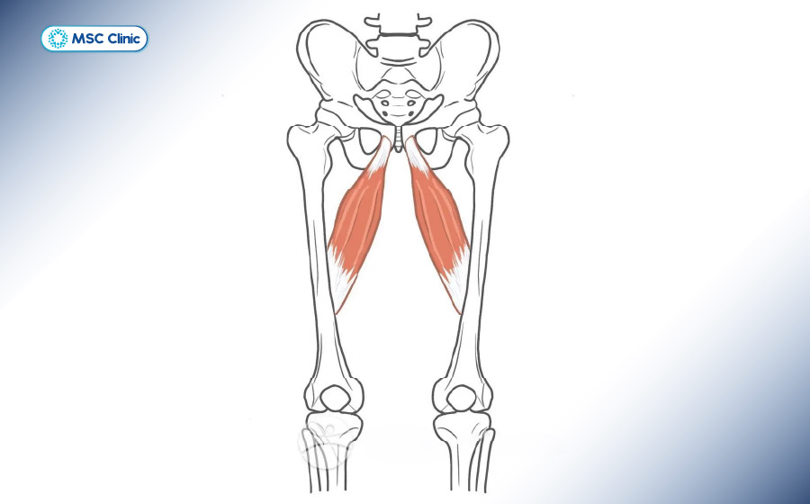 Viêm gân cơ khép có thể gây đau vùng háng và dễ nhầm với căng cơ háng Viêm gân cơ khép có thể gây đau vùng háng và dễ nhầm với căng cơ háng
