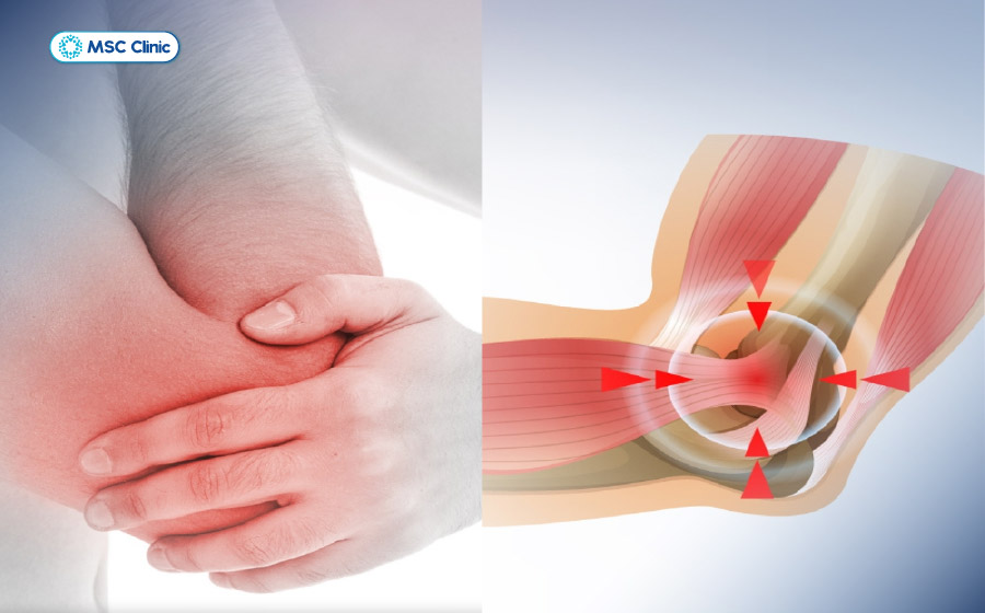Viêm gân gây đau nhức xương khớp vào ban đêm, khiến người bệnh mất ngủ thường xuyên