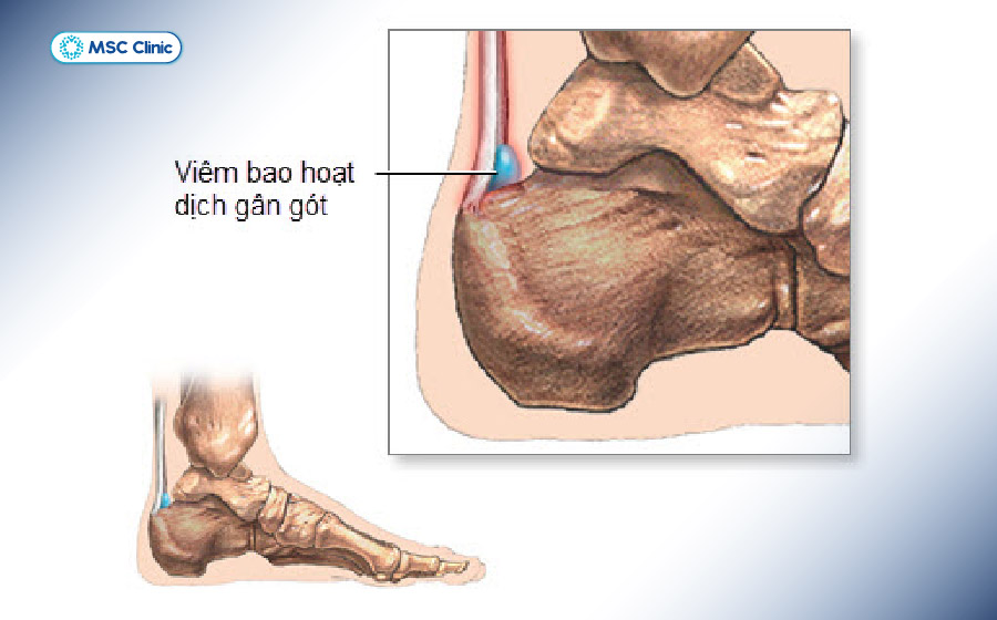 Viêm gân, viêm bao hoạt dịch hoặc u nang hoạt dịch là những nguyên nhân gây hẹp ống cổ chân Viêm gân, viêm bao hoạt dịch hoặc u nang hoạt dịch là những nguyên nhân gây hẹp ống cổ chân