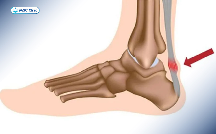 Viêm gân, viêm khớp hoặc tổn thương quanh cổ chân là những nguyên nhân thường gặp gây đau cổ chân sau khi ngủ dậy Viêm gân, viêm khớp hoặc tổn thương quanh cổ chân là những nguyên nhân thường gặp gây đau cổ chân sau khi ngủ dậy