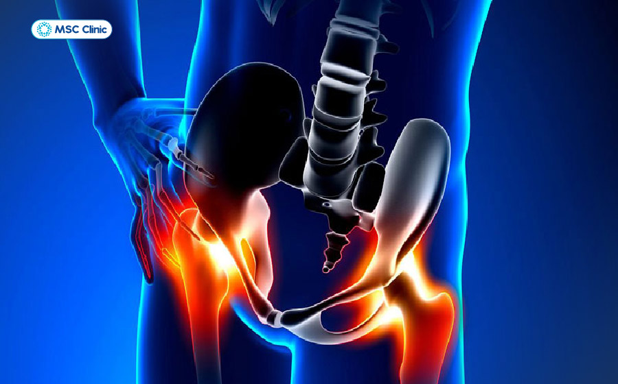 Viêm khớp háng có thể gây đau vùng háng, đùi hoặc mông, ảnh hưởng đáng kể đến sinh hoạt hằng ngày Viêm khớp háng có thể gây đau vùng háng, đùi hoặc mông, ảnh hưởng đáng kể đến sinh hoạt hằng ngày