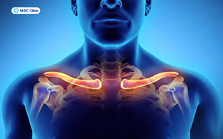 Viêm khớp ức đòn là tình trạng cần được phát hiện sớm và điều trị đúng cách