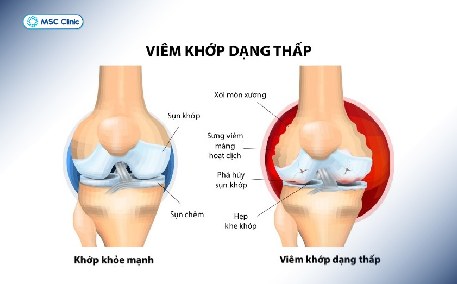 Viêm màng hoạt dịch kéo dài có thể làm giảm tiết dịch nhờn trong khớp Viêm màng hoạt dịch kéo dài có thể làm giảm tiết dịch nhờn trong khớp