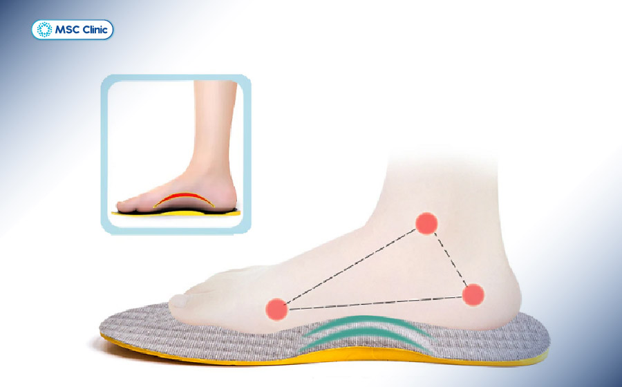 Đế lót chỉnh hình có thể giúp phân bố lại áp lực lên bàn chân khi được lựa chọn đúng