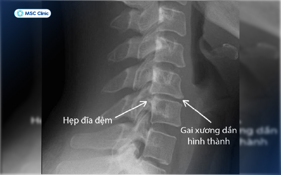 Hình ảnh gai cột sống trên phim X-quang