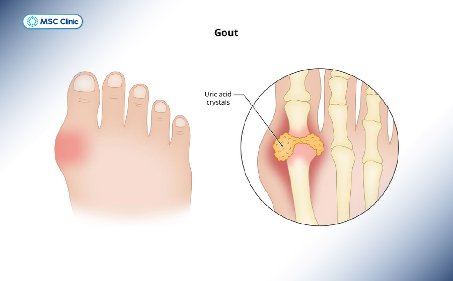 Một số loại thực phẩm có thể gây tích tụ acid uric và kích thích các cơn gout cấp Một số loại thực phẩm có thể gây tích tụ acid uric và kích thích các cơn gout cấp