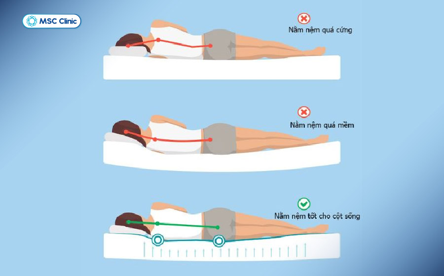 Nằm đệm không phù hợp trong thời gian dài có thể gây đau lưng khi ngủ