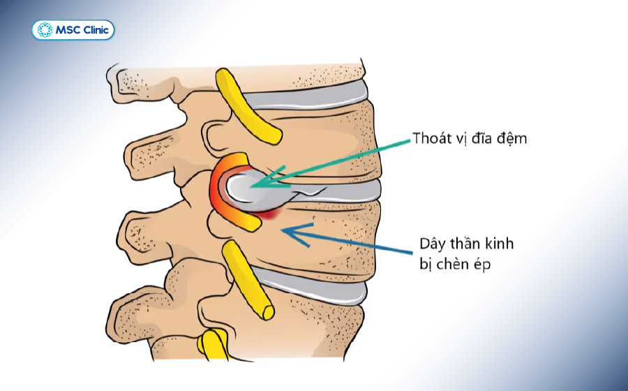 Thoát vị đĩa đệm khiến dây thần kinh bị chèn ép gây ra những cơn đau lưng về đêm