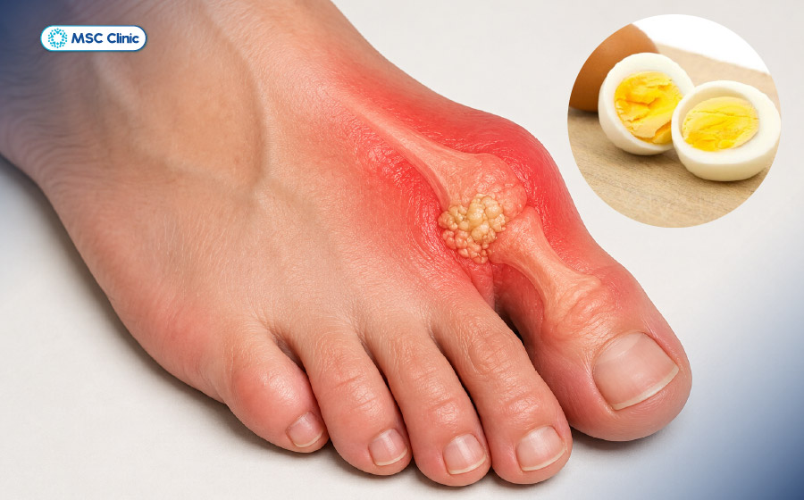 Bệnh gút có ăn được trứng gà không? - Có vì trứng gà chứa lượng purin rất ít Bệnh gút có ăn được trứng gà không? - Có vì trứng gà chứa lượng purin rất ít