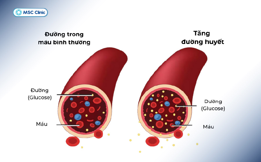 Bệnh tiểu đường xảy ra khi lượng glucose trong máu tăng cao do thiếu insulin hoặc cơ thể sử dụng insulin không hiệu quả 