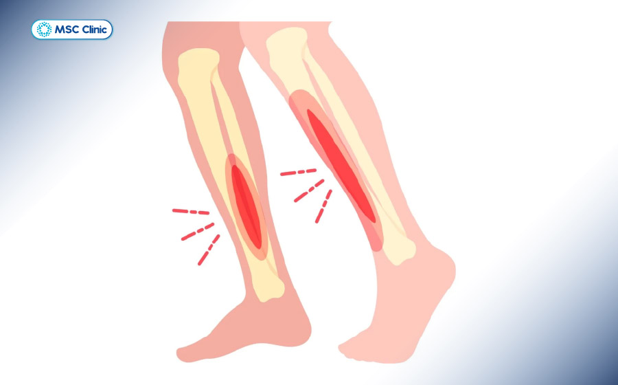 Bị đau buốt trong xương ống chân là tình trạng cần được quan tâm đặc biệt