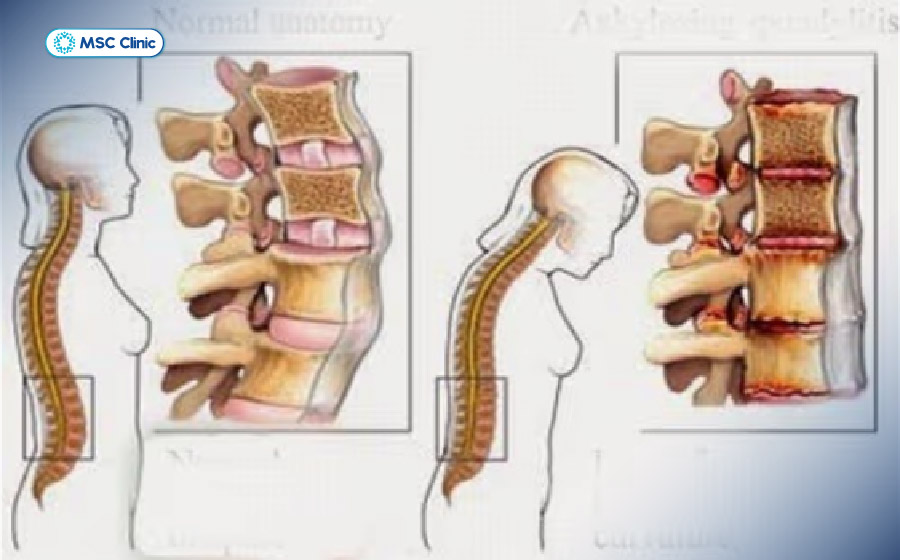 Các bệnh về cột sống có thể ảnh hưởng đến đốt sống, đĩa đệm, khớp, dây chằng Các bệnh về cột sống có thể ảnh hưởng đến đốt sống, đĩa đệm, khớp, dây chằng