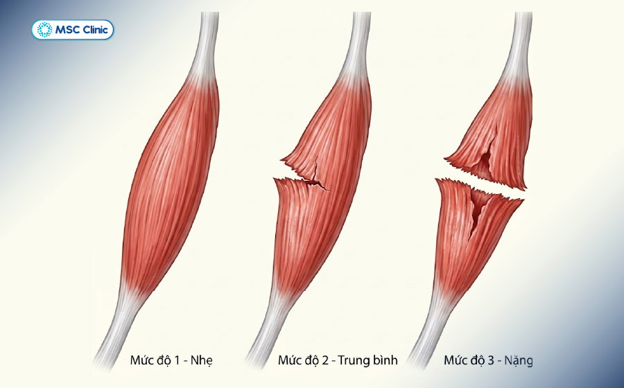 Các cấp độ căng cơ Các cấp độ căng cơ