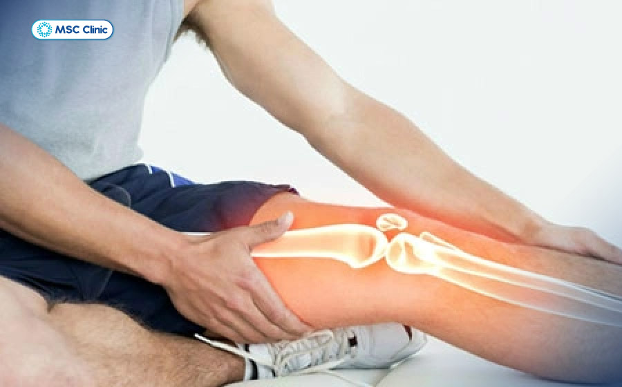 Các đợt khuỵu gối lặp lại có thể làm tăng nguy cơ tổn thương thêm sụn chêm và các cấu trúc trong khớp Các đợt khuỵu gối lặp lại có thể làm tăng nguy cơ tổn thương thêm sụn chêm và các cấu trúc trong khớp