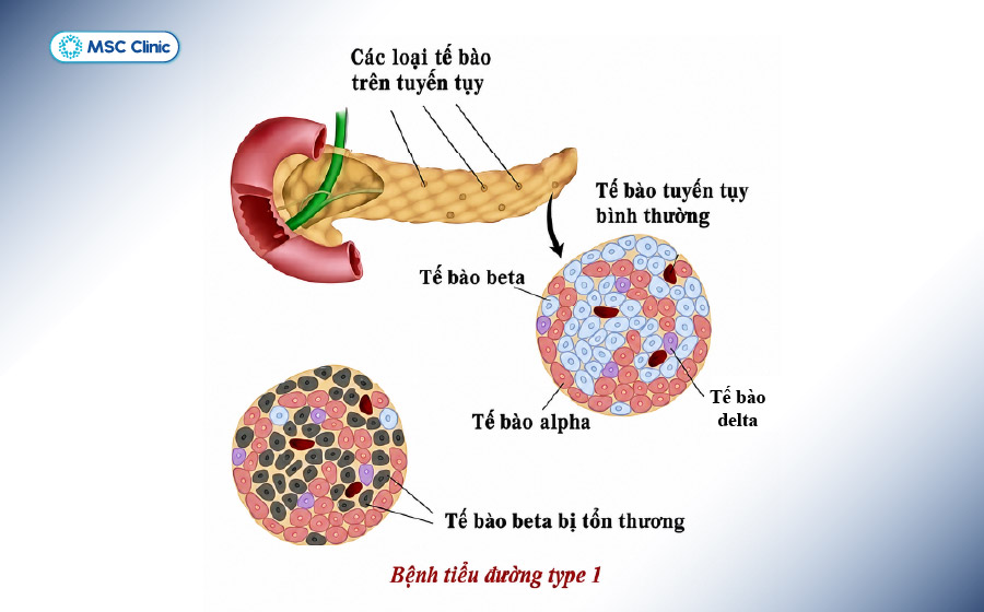 Các tế bào beta trong tuyến tụy đóng vai trò quan trọng trong sản xuất Insulin