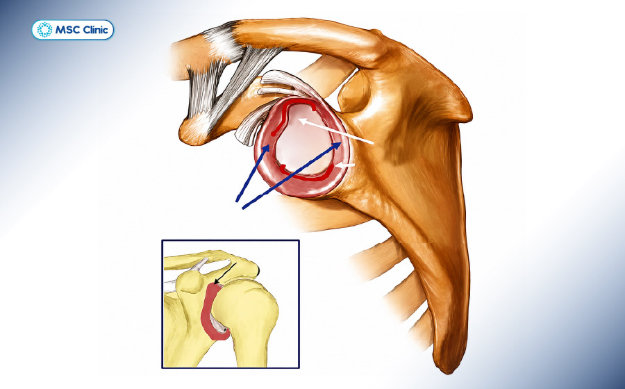 Các vị trí có thể rách sụn viền khớp vai