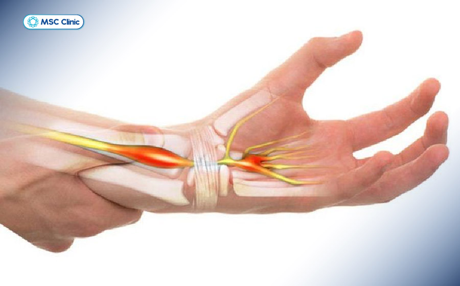 Cấu trúc ống cổ tay và dây thần kinh giữa 