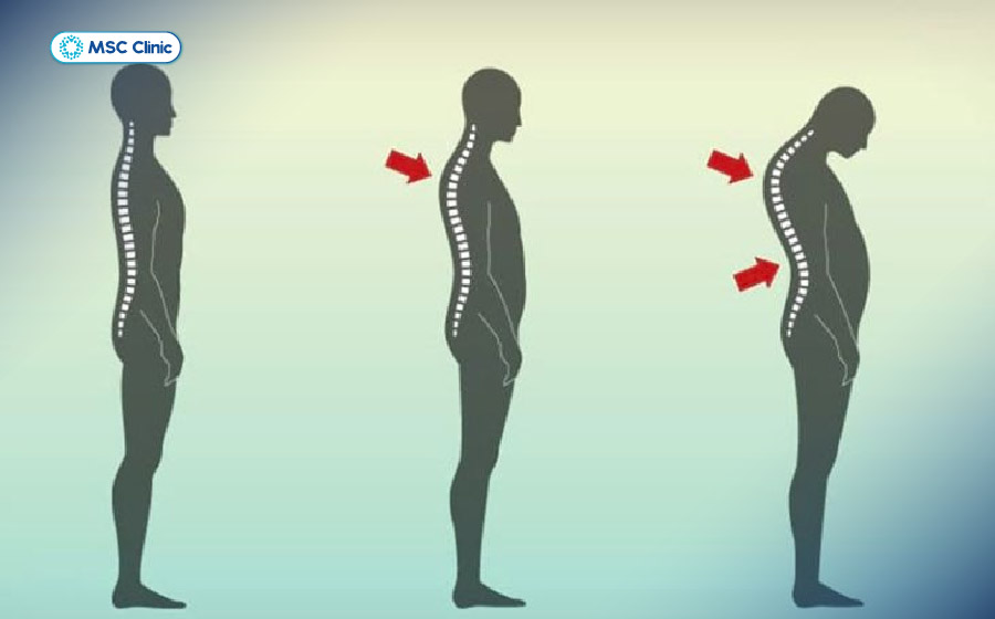 Chú ý đến tư thế, dáng đi bất thường có thể giúp phát hiện sớm loãng xương Chú ý đến tư thế, dáng đi bất thường có thể giúp phát hiện sớm loãng xương