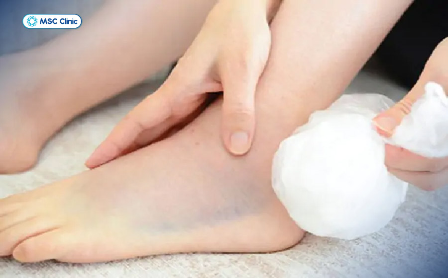 Chườm lạnh trong giai đoạn đầu có thể giúp giảm đau và giảm viêm đối với một số trường hợp đau gót chân do quá tải