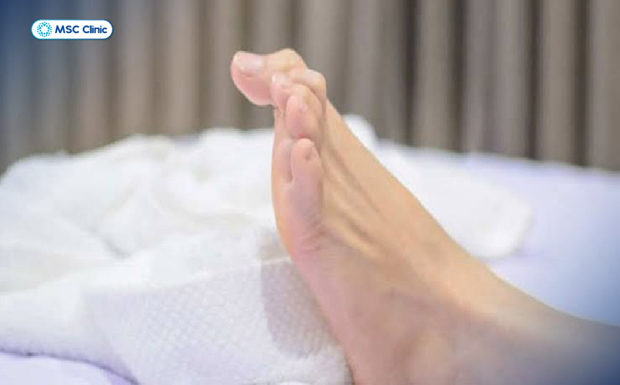 Chuột rút ngón chân có thể xảy ra ở mọi lứa tuổi và nhiều nguyên nhân khác nhau Chuột rút ngón chân có thể xảy ra ở mọi lứa tuổi và nhiều nguyên nhân khác nhau