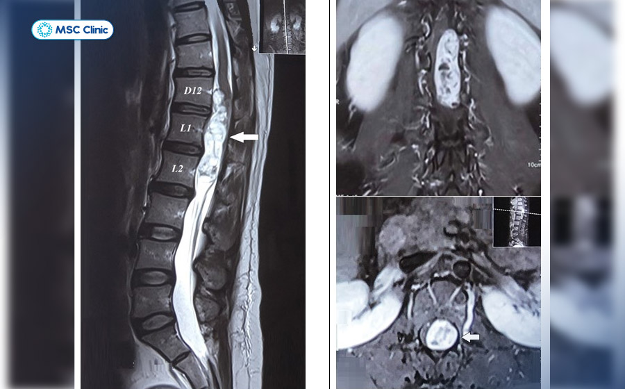 Chụp MRI có phát hiện ung thư không? - Hình ảnh khối u tủy sống trên phim chụp cộng hưởng từ