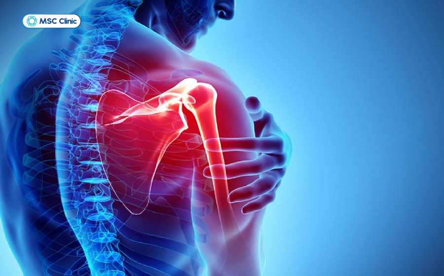 Cơn đau cơ vai có thể lan xuống bắp tay Cơn đau cơ vai có thể lan xuống bắp tay
