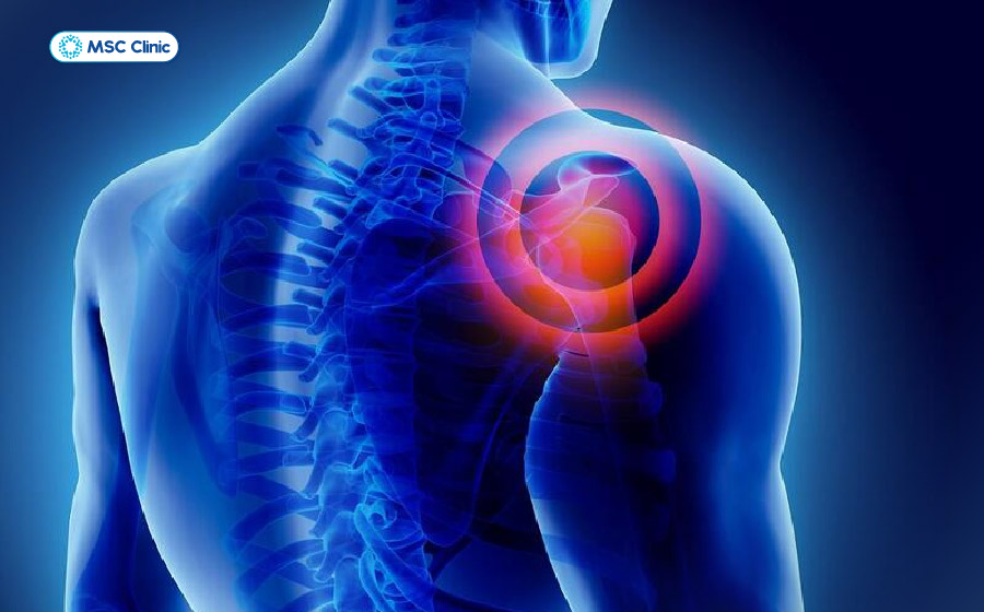 Cơn đau mỏi âm ỉ, căng cứng tại vai khiến người bệnh mệt mỏi, gặp nhiều khó khăn trong sinh hoạt Cơn đau mỏi âm ỉ, căng cứng tại vai khiến người bệnh mệt mỏi, gặp nhiều khó khăn trong sinh hoạt