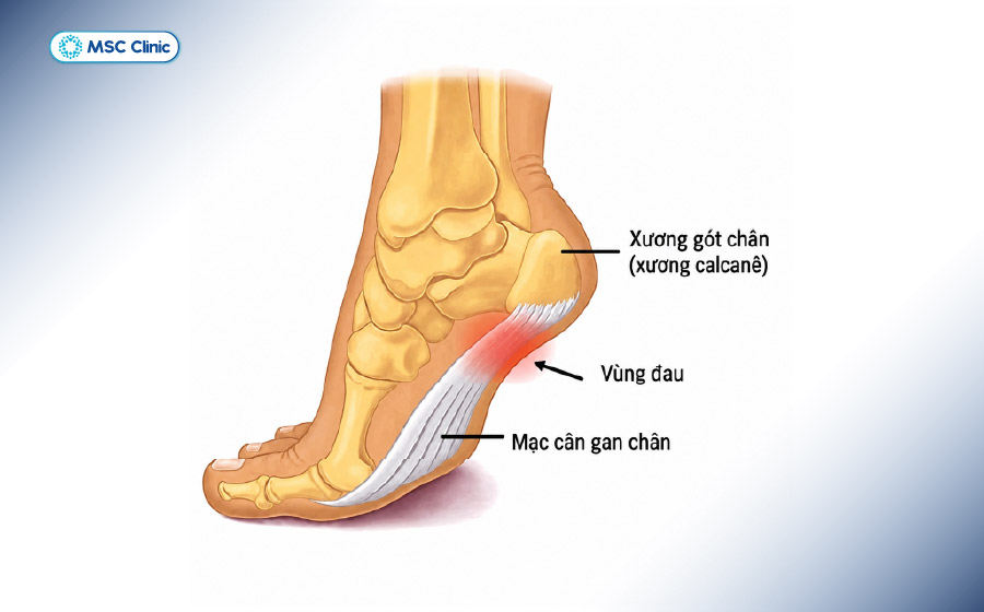 Cơn đau thường xuất hiện ở mặt dưới hoặc phía sau gót chân, có thể tăng lên khi chạy, đi bộ hoặc đứng lâu