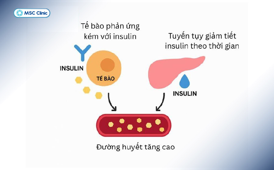 Đái tháo đường type 2 xảy ra khi cơ thể không sử dụng insulin hiệu quả hoặc không sản xuất đủ insulin