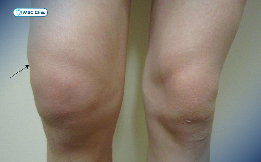 Đầu gối sưng to có thể là dấu hiệu cảnh báo tràn dịch khớp gối Đầu gối sưng to có thể là dấu hiệu cảnh báo tràn dịch khớp gối
