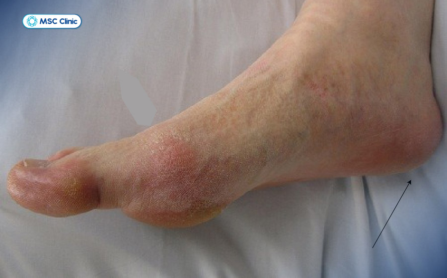 Đau gót chân ở người mắc bệnh gout thường xuất hiện đột ngột, kèm sưng và tăng đau khi chịu lực Đau gót chân ở người mắc bệnh gout thường xuất hiện đột ngột, kèm sưng và tăng đau khi chịu lực
