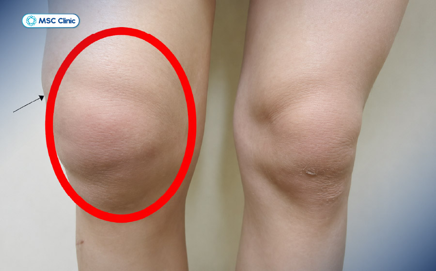 Đau khớp gối khi chạy bộ có thể kèm tình trạng sưng và nóng khớp