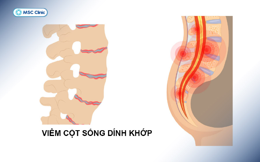 Hình ảnh các gai xương mọc dài và gắn kết các đốt sống thắt lưng thành một khối cố định do viêm cột sống dính khớp Hình ảnh các gai xương mọc dài và gắn kết các đốt sống thắt lưng thành một khối cố định do viêm cột sống dính khớp