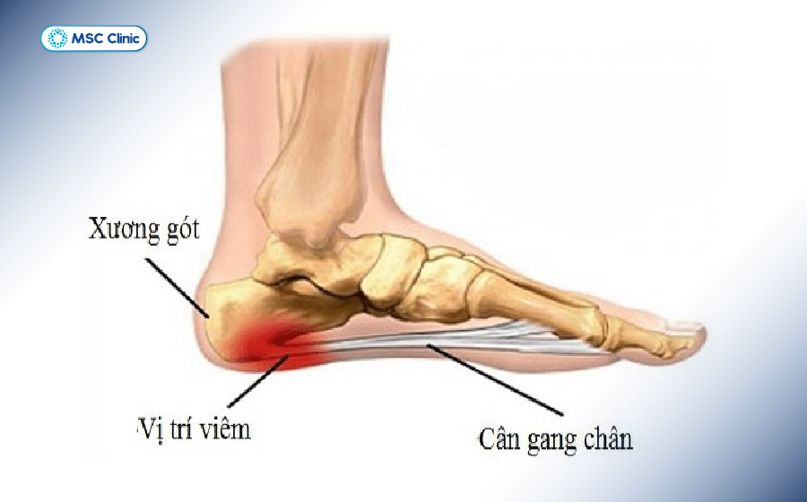 Hình ảnh cân gan chân bị viêm, gây đau và căng tức vùng gót chân Hình ảnh cân gan chân bị viêm, gây đau và căng tức vùng gót chân