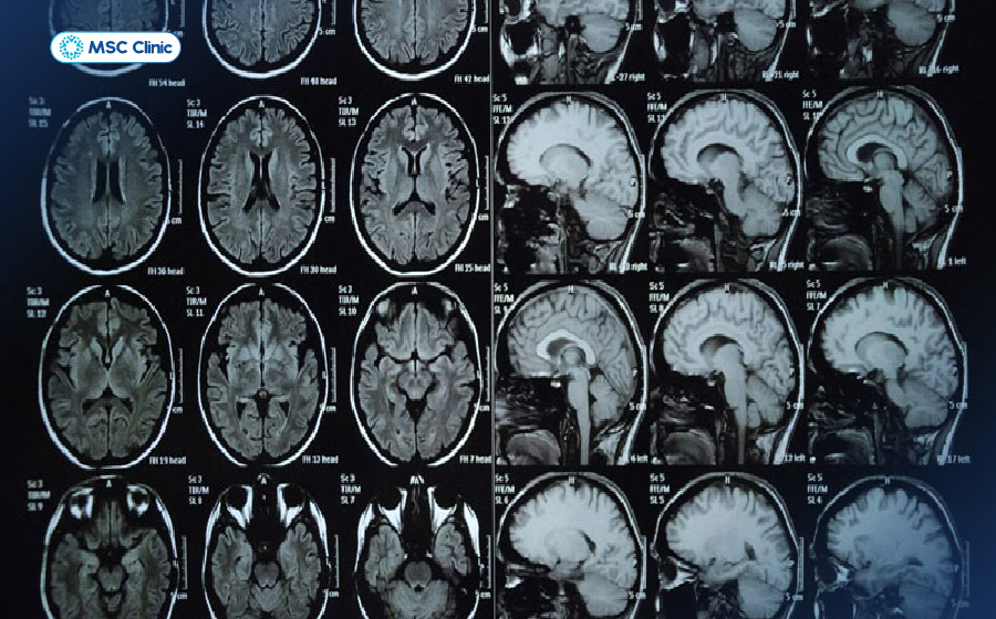 Hình ảnh chụp MRI não bộ