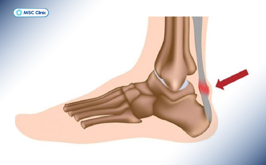 Hình ảnh gân Achilles bị viêm và dày lên, gây đau vùng phía sau gót chân Hình ảnh gân Achilles bị viêm và dày lên, gây đau vùng phía sau gót chân