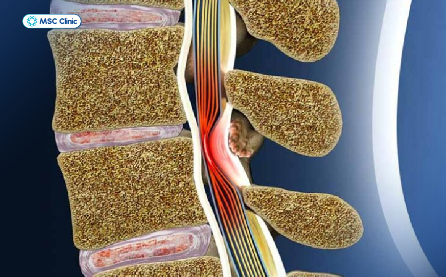 Hình ảnh mô phỏng hẹp ống sống gây tình trạng đau nhức ở thắt lưng
