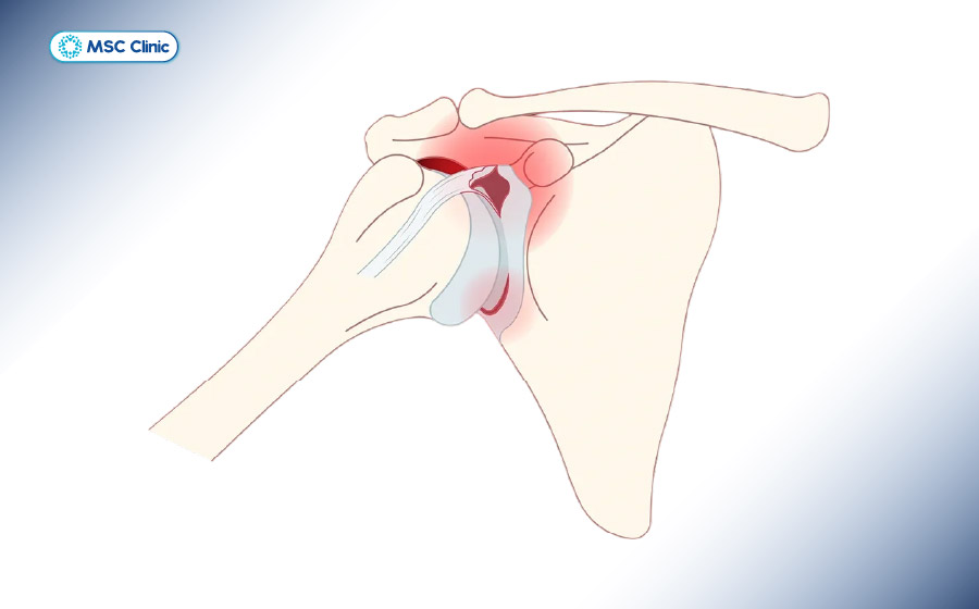 Hình ảnh mô phỏng rách sụn viền khớp vai