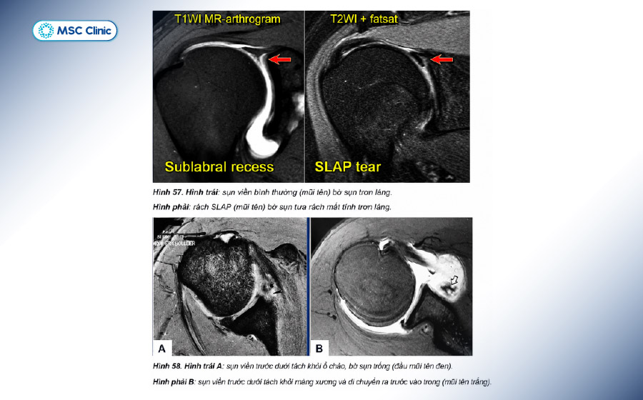 Hình chụp MRI rách sụn viền khớp vai