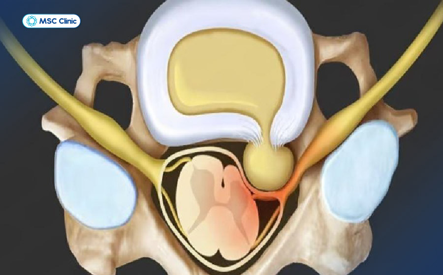 Khi rễ thần kinh cổ bị chèn ép, người bệnh có thể xuất hiện đau cổ kèm tê bì hoặc yếu cánh tay theo đường đi của dây thần kinh
