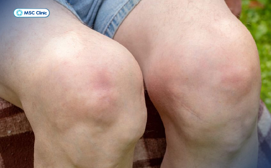 Khớp gối bị biến chứng nghiêm trọng do viêm khớp tự miễn