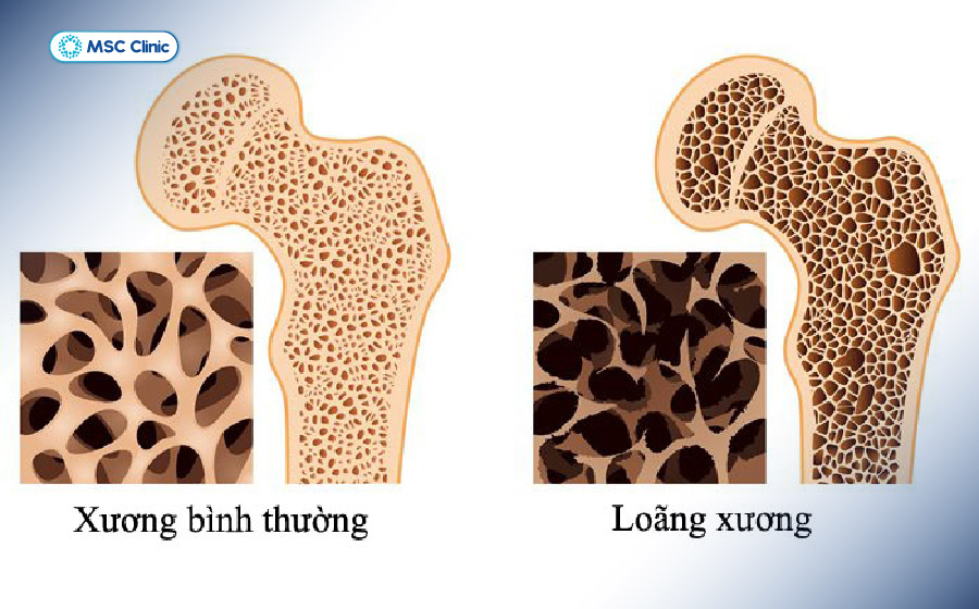Mật độ xương suy giảm khi loãng xương
