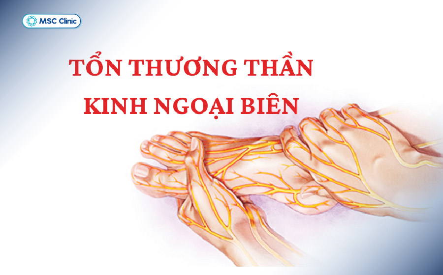 Một số trường hợp viêm dây thần kinh hoặc bệnh thần kinh ngoại biên không xác định được nguyên nhân, được gọi là bệnh thần kinh ngoại biên vô căn Một số trường hợp viêm dây thần kinh hoặc bệnh thần kinh ngoại biên không xác định được nguyên nhân, được gọi là bệnh thần kinh ngoại biên vô căn