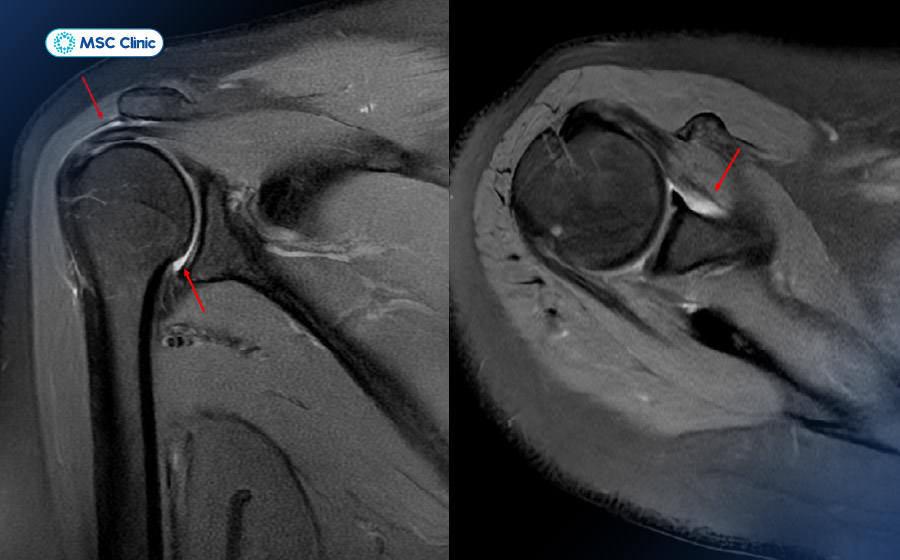 MRI khớp vai cho hình ảnh chi tiết của sụn viền, gân chóp xoay, bao khớp và các mô mềm chính xác MRI khớp vai cho hình ảnh chi tiết của sụn viền, gân chóp xoay, bao khớp và các mô mềm chính xác