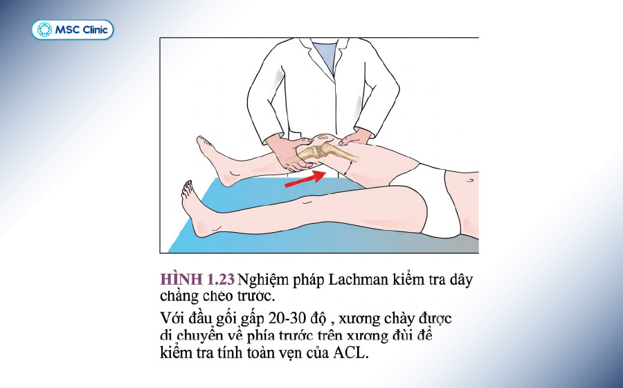 Nghiệm pháp Test Lachman giúp bác sĩ đánh giá tổn thương dây chằng khớp gối